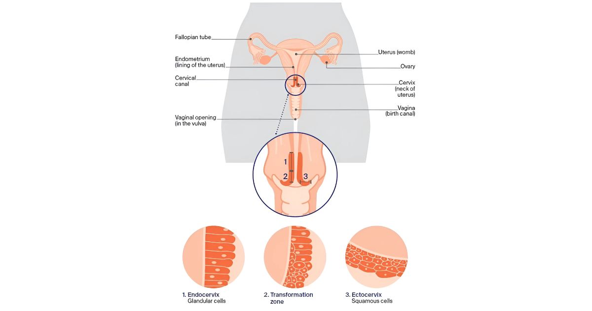 TẦM SOÁT UNG THƯ CỔ TỬ CUNG – VAI TRÒ CỦA XÉT NGHIỆM HPV