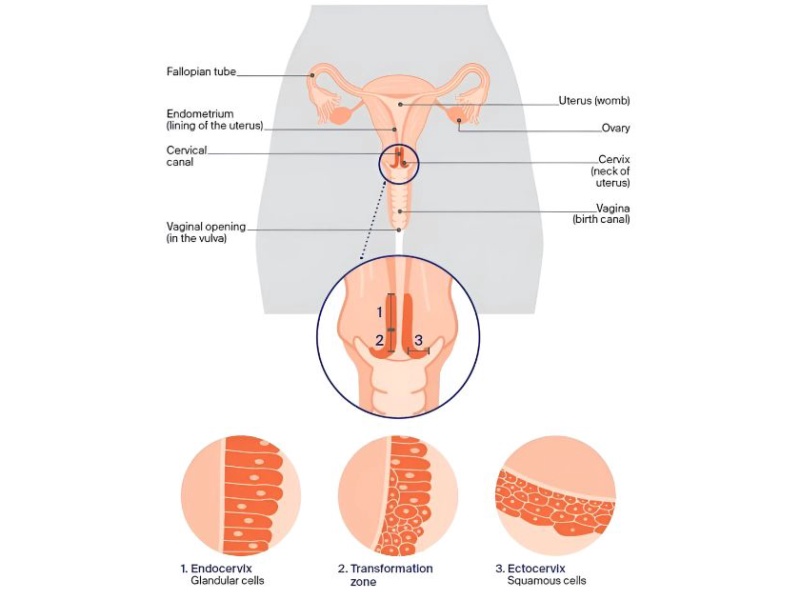 TẦM SOÁT UNG THƯ CỔ TỬ CUNG – VAI TRÒ CỦA XÉT NGHIỆM HPV